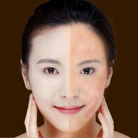 Blue Light Therapy Acne Laser Pen Skin Care